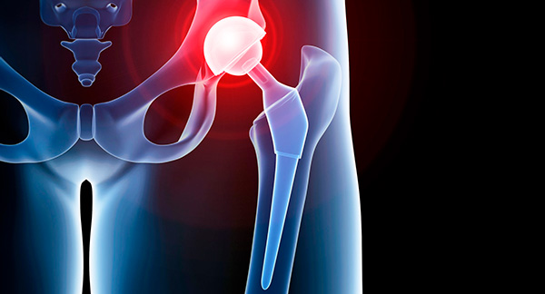 Hip Replacement Surgery