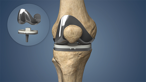 Dr. Prasanna performing robotic knee replacement surgery in Yeshwanthpur Bangalore
