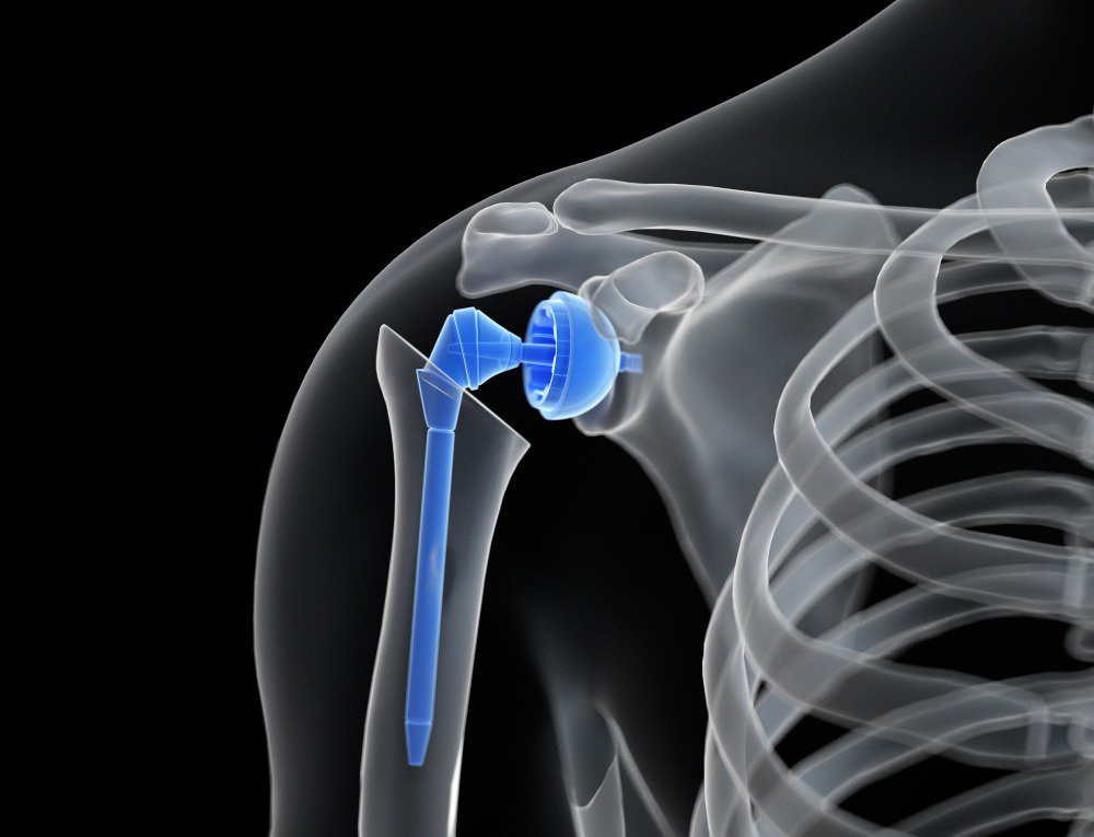 Shoulder Replacement Surgery